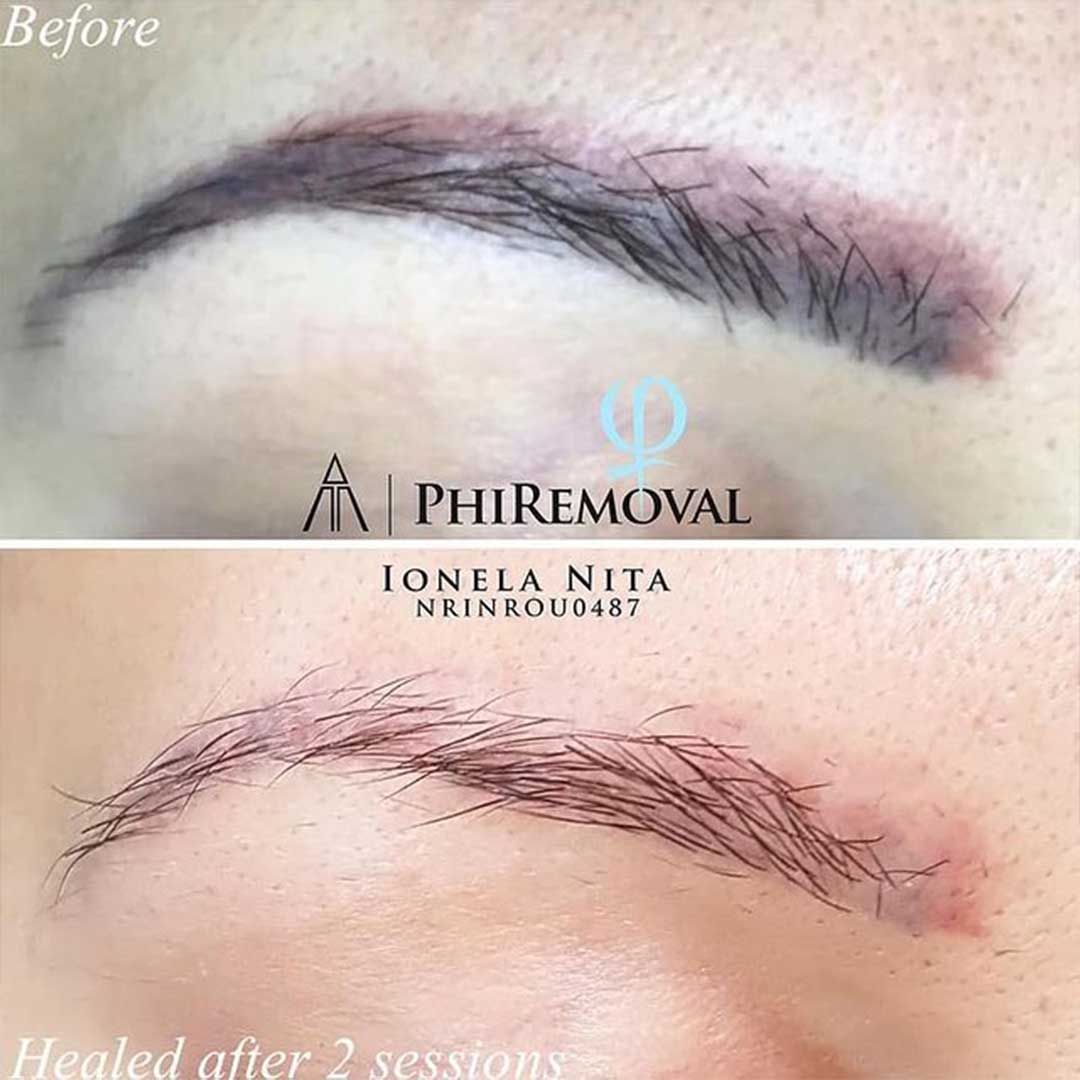 PERMANENT MAKE-UP ENTFERNUNG