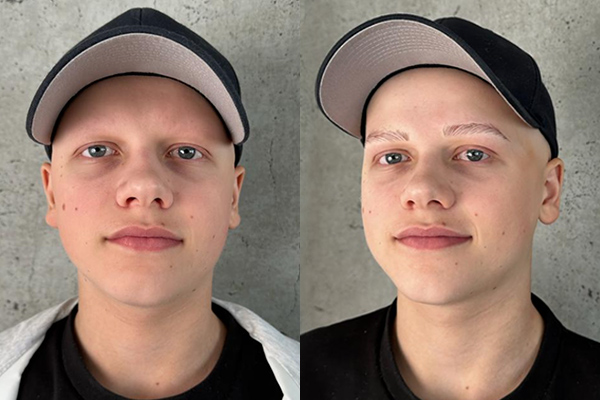 Augenbrauen Rekonstruktion mit Hilfe von Microblading bei Alopecia